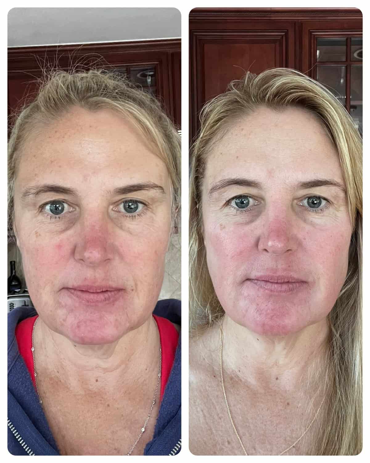 red light therapy before and after 30 days